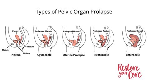 Understanding Pelvic Floor Prolapse: Causes, Symptoms, and Life-Changing Treatment Options