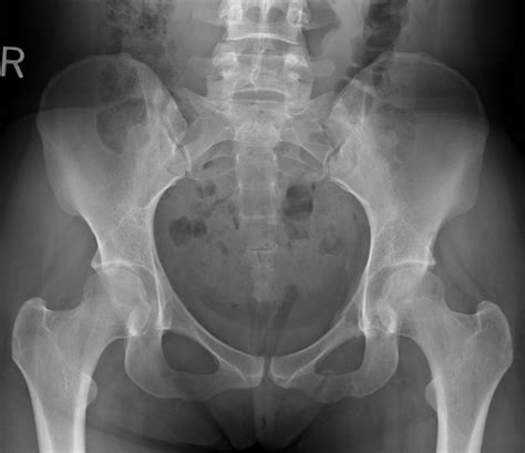 Pelvis X-Ray: Detecting Hidden Injuries