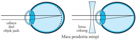 Penderita Miopi: Kelebihan dan Kekurangan