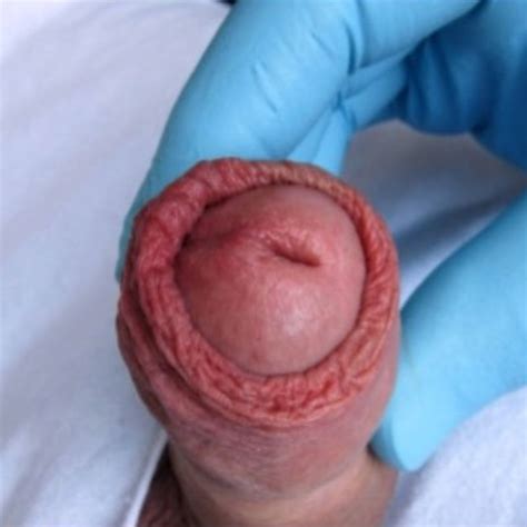 Penis Surgery Breakthrough: What You Need to Know About Recent Advances