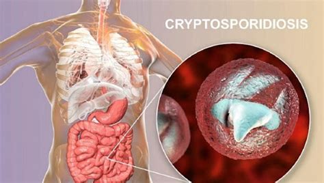 Penyakit Cryptosporidiosis atau Penyakit Saluran Cerna Akibat Cryptosporidium