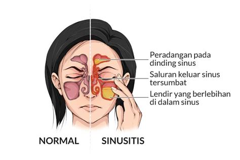 penyebab sinusitis