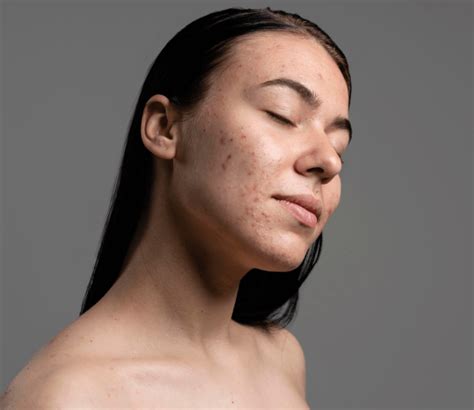 penyebab wajah bruntusan akibat skincare