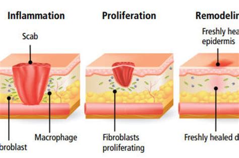 Manfaat Amoksisilin untuk Penyembuhan Luka