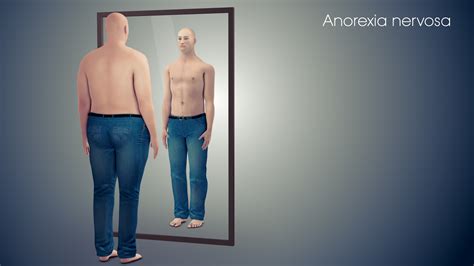 people suffering from anorexia nervosa