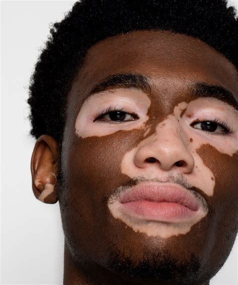 people with vitiligo pictures