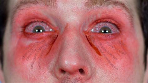 Pepper Spray Eye Damage
