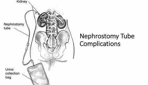 Percutaneous Nephrostomy Tube Placement Nephrostogram Obtained 3 Days Following
