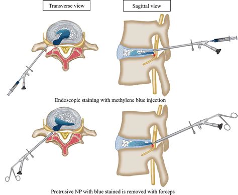 percutaneous discectomy cpt code