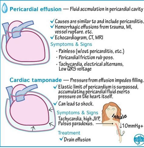 Understanding Pericardial Effusion Causes: A Comprehensive Guide