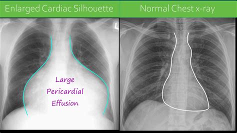 pericardial effusion cxr