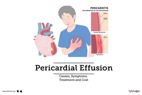 Understanding Pericardial Effusion Symptoms: Early Warning Signs and Complications
