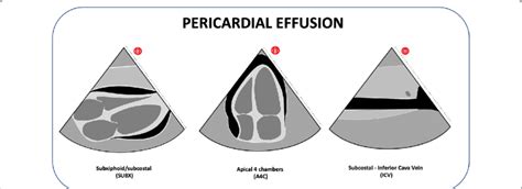 pericardial tamponade vs pericardial effusion