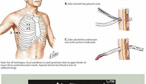 Pericardiostomy Tube Insertion CTGuided For Postsurgical