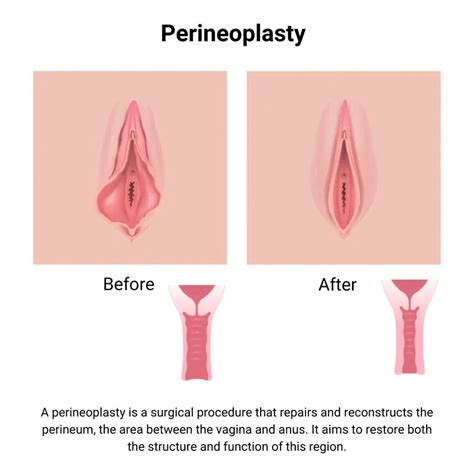 perineoplasty