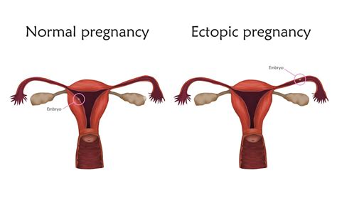 Side Effects After Ectopic Pregnancy Surgery Connecticut