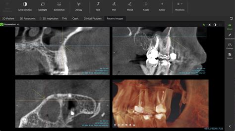 periodontal abscess cbct
