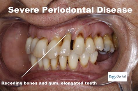 periodontal disease bone loss treatment