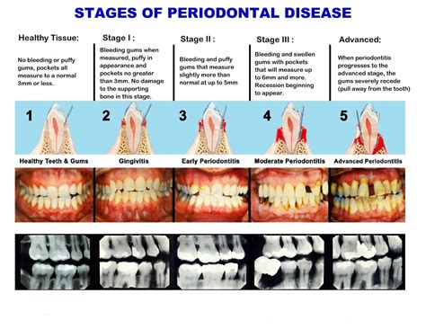 periodontal disease progression chart