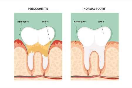 Periodontitis Treatment Cost Without Insurance