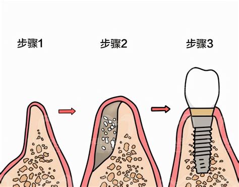 Periosteum Dental Implants