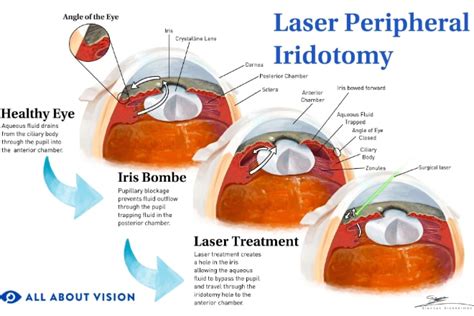 Peripheral Laser Iridotomy Surgery