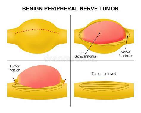 Malignant Peripheral Nerve Sheath Tumor in Neurofibromatosis Type 1