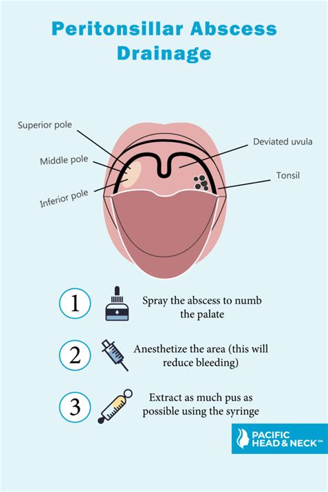 Peritonsillar Abscess Drainage: What You Need to Know About This Critical Procedure