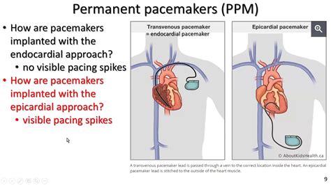 permanent epicardial pacemaker