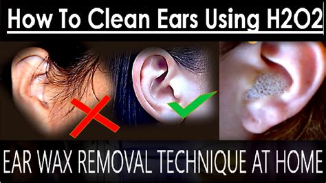 Using Peroxide in Ears: Safe or Risky Practice?