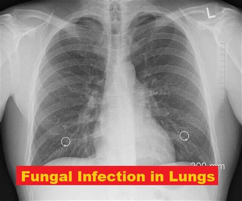 persistent chest infection