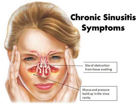 persistent sinus infection
