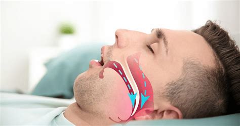 pertolongan pertama pada sleep apnea