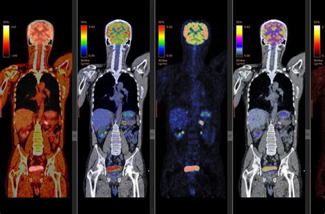 What Is a PET CT Scan and How Does It Work?
