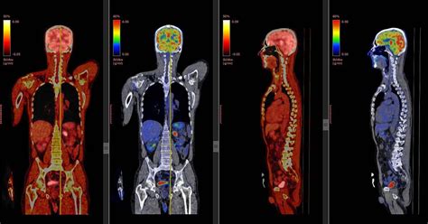 Pet Scan and Diagnosis: Unlocking Accurate Health Insights