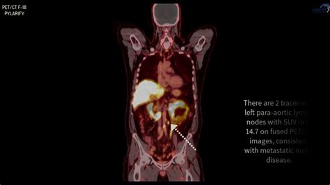 pet-ct f18