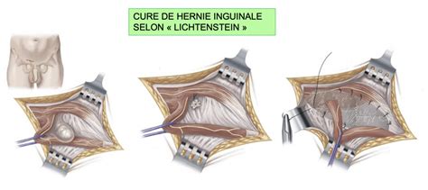 Comprendre les douleurs après une opération d