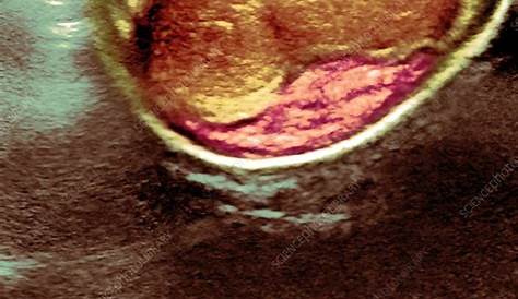 Peyronies Disease Plaque Academic Learning Of Urology Procedures Videos