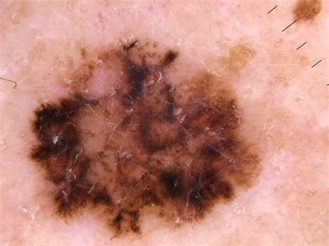 photo of melanoma skin cancer