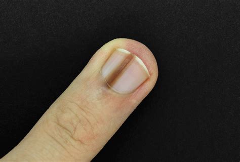 photos of nail melanoma