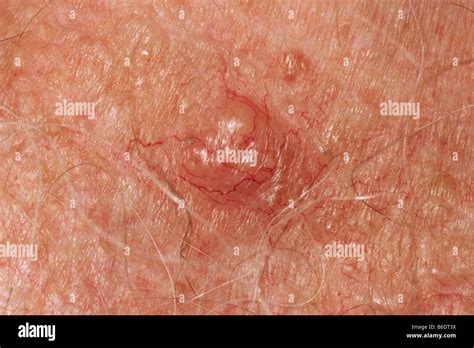 photos of skin cancer on chest