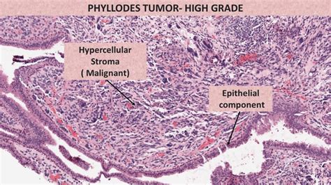 Qiao's Pathology Malignant Phyllodes Tumor of the Breast … Flickr