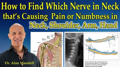 physio causing more pain with nerves in neck