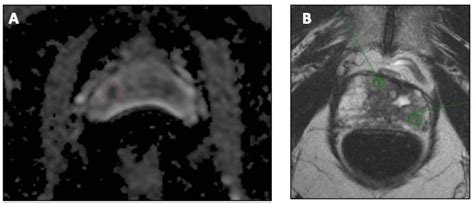 pi-rads category 3 lesion