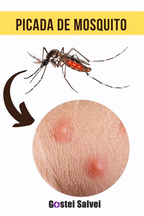 picada do mosquito da dengue