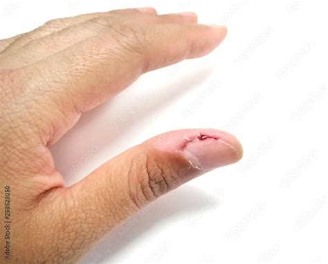 Picking Fingernails Disorder