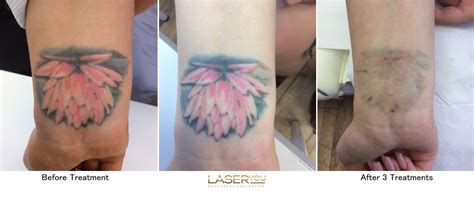 pico laser treatment tattoo removal