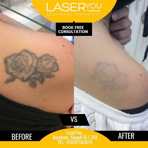 picosure tattoo removal perth