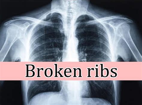 picture broken ribs