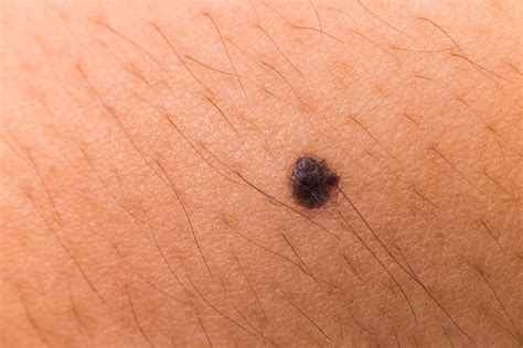 picture of a melanoma mole